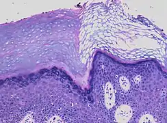 In contrast, hyperkeratosis (pictured) may also show a heterogeneous stratum corneum, but a preserved granular layer is seen.