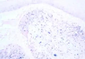 Image of human papilloma virus associated oropharyngeal cancer, under a microscope. The tissue has been stained to show the presence of the virus by in situ hybridisation