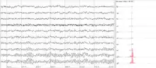 Human EEG with prominent resting state activity – alpha-rhythm. Left: EEG traces (horizontal – time in seconds; vertical – amplitudes, scale 100 μV). Right: power spectra of shown signals (vertical lines – 10 and 20 Hz, scale is linear). Alpha-rhythm consists of sinusoidal-like waves with frequencies in 8–12 Hz range (11 Hz in this case) more prominent in posterior sites. Alpha range is red at power spectrum graph.