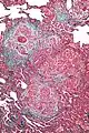 High magnification micrograph of hypersensitivity pneumonitis showing granulomatous inflammation. Trichrome stain.