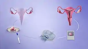 A depiction of the procedure of in-vitro fertilization