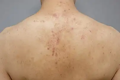 Keratosis Pilaris on Back