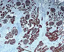 CD10 immunohistochemical staining of normal kidney. CD10 stains the proximal convoluted tubules and glomeruli.