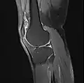 Knee MRI (PD TSE FS sagittal)