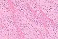 High magnification micrograph showing laminations in a thrombus in a fatal pulmonary embolism. H&E stain.