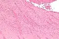 Intermediate magnification micrograph showing laminations in a thrombus in a fatal pulmonary embolism. H&E stain.