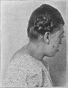 Pfeiffer syndrome