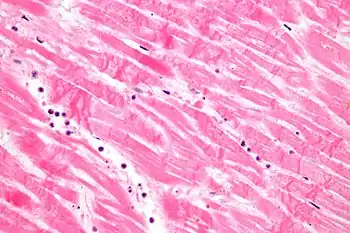 Micrograph showing karyolysis and contraction band necrosis in an individual that had a myocardial infarction (heart attack).