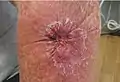 Malignant Melanoma left forearm post excision with purse-string closure