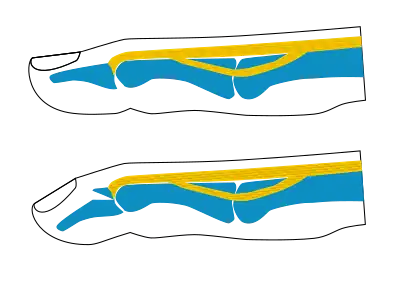 Busch fracture mechanism: because the bit of bone attached to the tendon has broken off, the tendon can't extend the finger tip