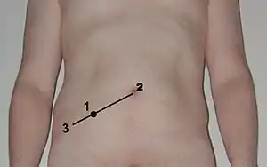 Location of McBurney's point (1), which is located two thirds the distance from the umbilicus (2) to the anterior superior iliac spine (3)