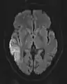 DWI showing cortical ribbon-like high signal consistent with diffusion restriction in a patient with known MELAS syndrome