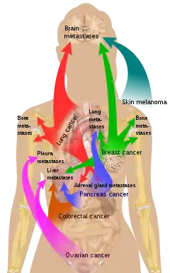 Main sites of metastases for some common cancer types, showing liver as the target for many types. Primary cancers are denoted by "...cancer" and their main metastasis sites are denoted by "...metastases".