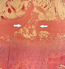 Micrograph of entry point of appendicular arteries (arrows at level of inner muscular layer), not to be confused with a perforation.