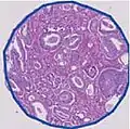 Gleason pattern 6 (3+3).