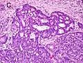 Gleason score 8 (4+4) with irregular cribriform glands