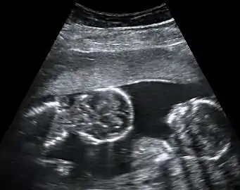 Abdominal ultrasonography of monoamniotic twins at a gestational age of 15 weeks. There is no sign of any membrane between the fetuses. A coronal plane is shown of the twin at left, and a sagittal plane of parts of the upper thorax and head is shown of the twin at right.