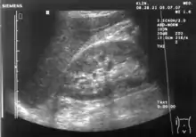 Ultrasound of liver (left side of the image) and right kidney (right side of the image) and Morison's pouch, not containing fluid