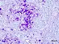 Histopathologic image of mucoepidermoid carcinoma. Postoperative recurrence of the submandibular tumor. Alcian blue-PAS stain