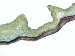 Movat's stain showing thickening of the spongiosa layer (blue) in myxomatous degeneration of the aortic valve.