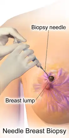 Needle breast biopsy