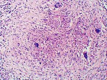 Granuloma with early suppuration. Fungal organisms difficult to recognize at this low magnification.