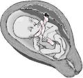 Nuchal cord - locked pattern