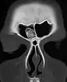 Osteoma of the frontal sinus on CT