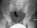 Osteopoikilosis