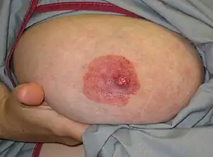 Paget's disease of the nipple