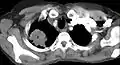 CT scan showing a Pancoast tumor (labeled as P, non-small cell lung carcinoma, left lung), from a 47-year-old female smoker