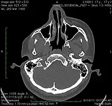 A CT image of the head of a 17-year-old girl with Parry–Romberg syndrome, showing atrophy of the subcutaneous tissue and underlying muscle, with no apparent involvement of the bone structure.