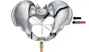 Superior view, Pelvic Fracture Types (2006).
Force and break are shown by matching color:
Anteroposterior compression type I (orange), Anteroposterior compression type  II (green), Anteroposterior compression type III (blue); Lateral compression type I (red), Lateral compression type II (purple), F. Lateral compression type III (black).
Increased force and breaks are shown by increasing size.