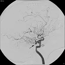 Persistent trigeminal artery