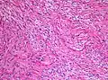 Histopathology of pilocytic astrocytoma (grade I WHO). H&E stain. Original magnification 200x.