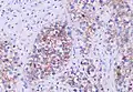 The germ cell markers OCT 3/4 and CD117 (positive immunohistochemistry pictured) are useful for diagnosis.