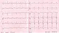 RBBB with associated first degree AV block