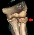 Radial head fracture seen on 3D CT reconstruction