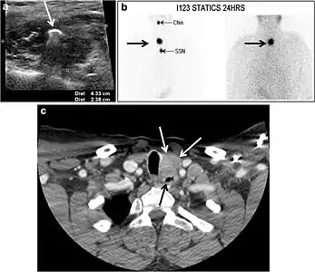 Fig. 8. A 48-year-old male patient post total thyroidectomy with PTC recurrence. a Transverse greyscale ultrasound of the neck demonstrates a left thyroid bed heterogeneous, predominantly hypoechoic irregular lesion with calcifications (white arrow). b A spot image of iodine 123 total body scan of the neck demonstrate a focus of abnormal radiotracer uptake at the left thyroid bed (Black arrows) between the annotated markers. c Enhanced axial CT scan of the neck demonstrates an enhancing large left thyroid bed mass (white arrow) with no calcifications. The lesion exerts a mass effect on the oesophagus (black arrow) and is inseparable from the trachea.