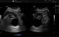 Renal cyst as seen on abdominal ultrasound