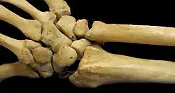 Distal ends of radius and ulna along with the bones of the wrist and hand