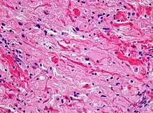 Histopathology of Rosenthal-fibres. H&E staining showing these elongated eosinophilic structures in the case of pilocytic astrocytoma. Magnification 400x