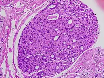 Histopathology of the cribriform type of breast ductal carcinoma in situ.