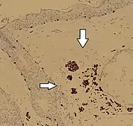 SOX10 immunohistochemistry in a dermal nevus, showing positively staining nevus cells (arrows)