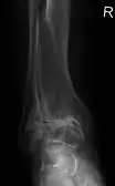 Frontal X-ray scan of ankle with secondary osteoarthritis