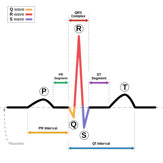 The EKG complex. P=P wave, PR=PR interval, QRS=QRS complex, QT=QT interval, ST=ST segment, T=T wave