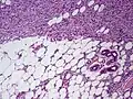 Subcutaneous tissue infiltration (i.e. "honeycomb" growth pattern)