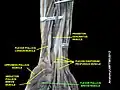 Flexor pollicis brevis muscle