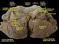 Cerebellum:—Inferior surface showing inferior cerebellar peduncle