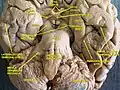 Cerebrum.Inferior view.Deep dissection.